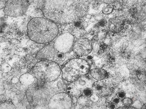 F, 36y. | chemodectoma - neck F, 36y. | chemodectoma - neck